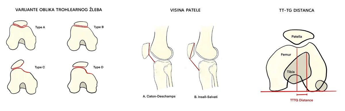 Anatomski faktori rizika za luksaciju patele: oblik trohlearnog žleba, visina patele i TT-TG distanca